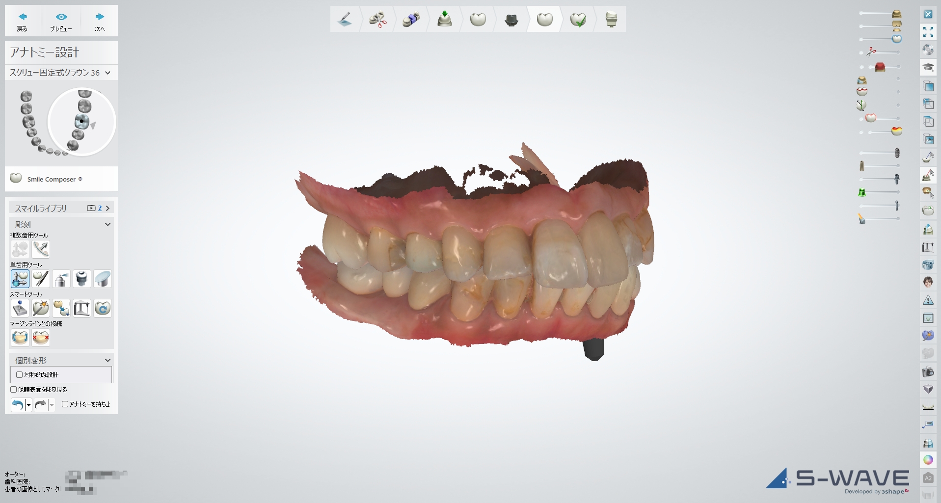 院内技工室で口腔内スキャナーの3Dデータを確認・デザインしている様子