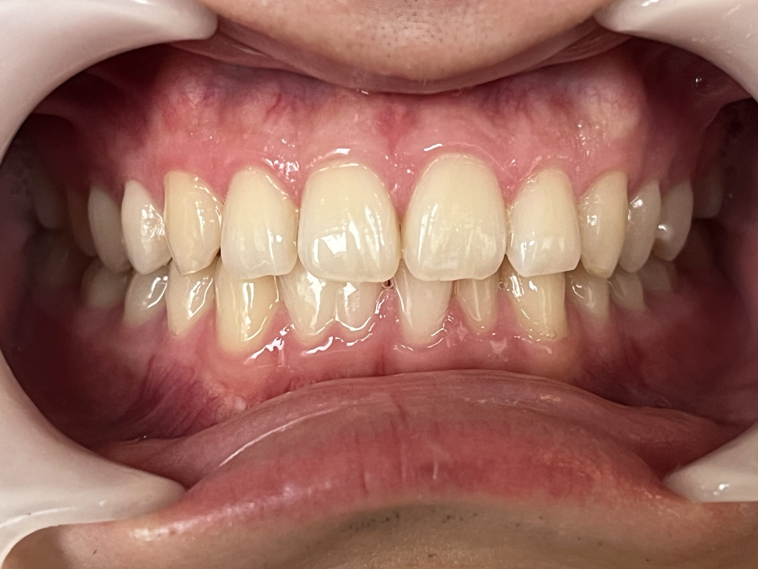 秋津の患者様のホワイトニング施術後の明るい歯