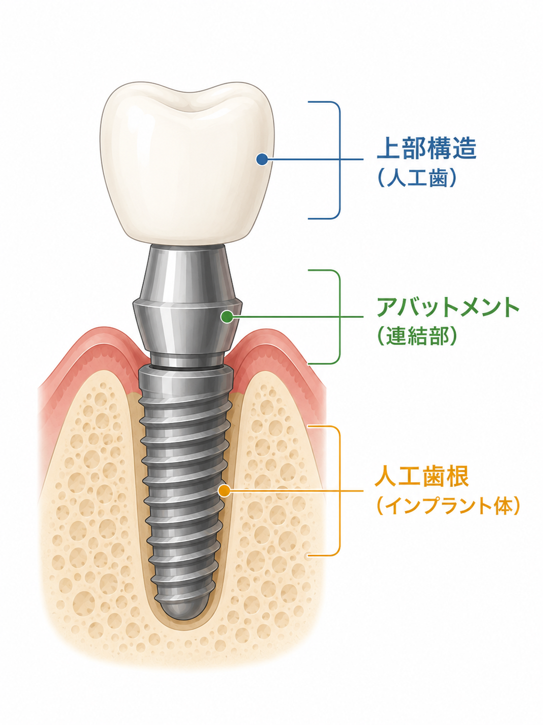 インプラントの構造（人工歯根・アバットメント・上部構造の3層構造）