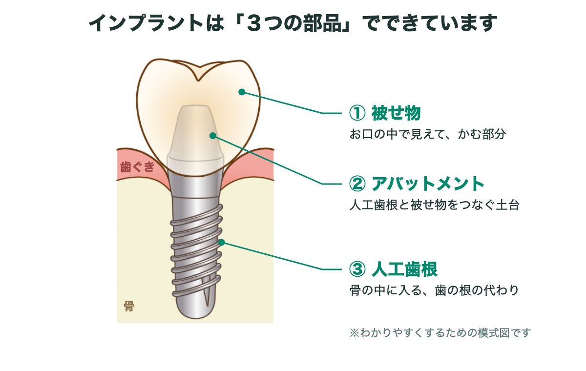 インプラントの３つの部品（被せ物・アバットメント・人工歯根）の図｜東村山 インプラント