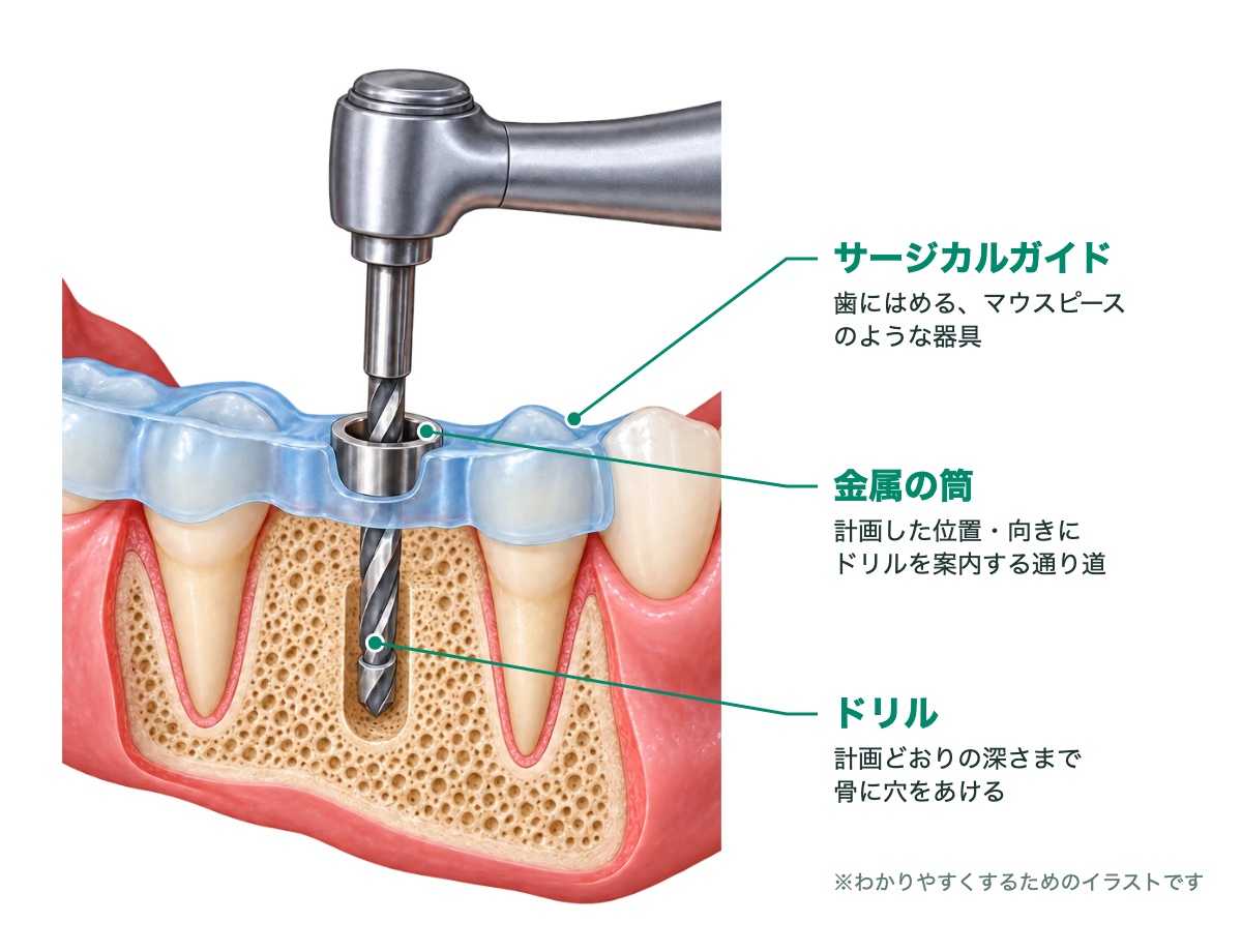 サージカルガイドを使ってインプラントの穴をあけるイラスト｜東村山 インプラント