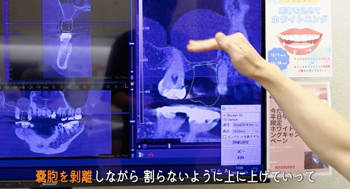 嚢胞を割らないように持ち上げる処置をCT画像で説明する様子|新秋津・秋津駅前まつばら歯科