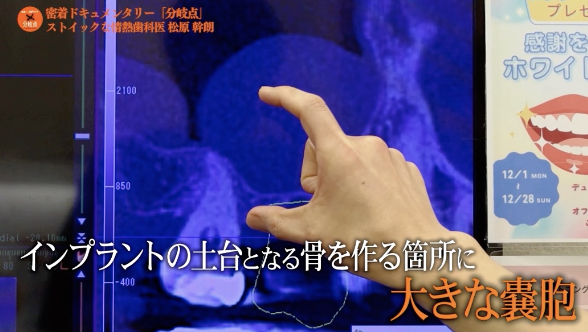 新秋津のインプラント｜土台となる骨を作る箇所の大きな嚢胞をＣＴ画像で示す様子 まつばら歯科