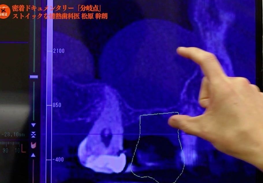 ＣＴ画像で骨の状態を確認する様子｜秋津のインプラント治療 新秋津・秋津駅前まつばら歯科