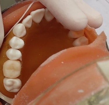 練習用の歯の模型に付けた奥歯の仮歯
